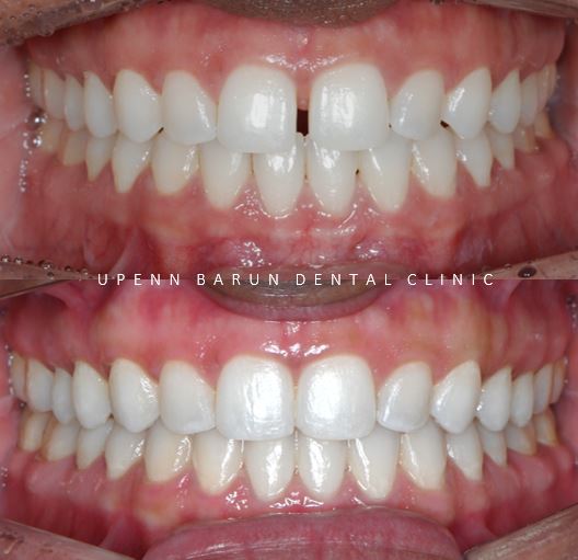 앞니벌어짐 인비절라인익스프레스로 해결하기 (인비절라인앞니부분교정 인비절라인재교정 송파인비절라인 잠실인비절라인 잠실교정치과 인비절라인익스프레스비용) 관련 이미지 3