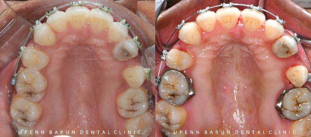 ABO 미국 치과교정과 전문의의 비수술치아교정 악궁확장장치 후기 (잠실교정전후 잠실새내교정치과 잠실교정치과 교정통증  앞니 변화) 관련 이미지 11