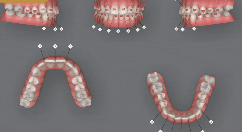 가지런했던 앞니가 삐뚤빼뚤해졌어요! 잠실다이아몬드등급 잠실인비절라인 인비절라인익스프레스 앞니 삐뚤어짐 해결(앞니급속교정 앞니투명교정 인비절라인급속교정 인비절라인전후사진) 관련 이미지 7