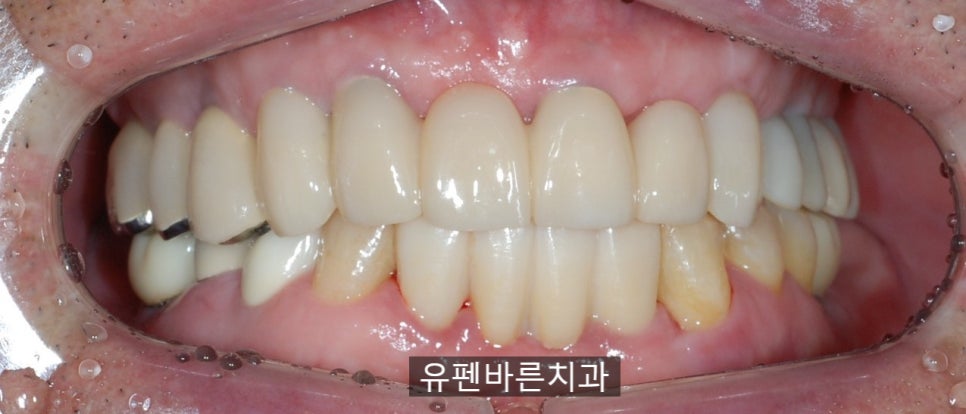 해보니까 임플란트가 편해요!!! 관련 이미지 6