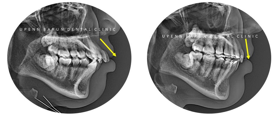 잠실돌출입교정 잠실발치교정 후기가 궁금하다면? (교정후얼굴변화후기 잠실교정치과 돌출입교정후기 돌출입전후사진) 관련 이미지 7