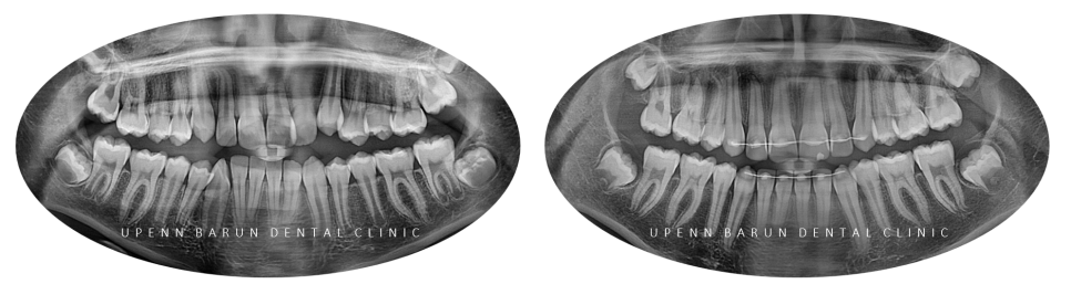 성장기에 돌출입이 고민이라면? 돌출입청소년교정 입술무력증 해결도 유펜바른치과에서! (잠실청소년교정 잠실돌출입교정 돌출입교정기간 발치교정외모변화 외국인교정치과) 관련 이미지 9