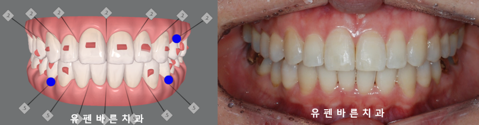 인비절라인으로 재교정, 가능할까용?? 관련 이미지 10