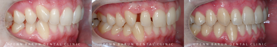 '옥니같이 보여요' 인비절라인급속교정 가능할까? with 캐리에모션장치 (잠실다이아몬드등급 인비절라인다이아몬드등급 서울다이아몬드등급치과 옥니인비절라인후기) 관련 이미지 5