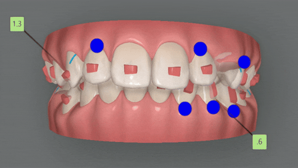 잠실소아인비절라인 잠실어린이인비절라인 송파인비절라인 잠실인비절라인후기 (잠실새내교정치과 엘스상가교정치과 파인애플상가교정치과 잠실새내역인비절라인 청소년교정후기 잠실인비절라인퍼스트) 관련 이미지 8