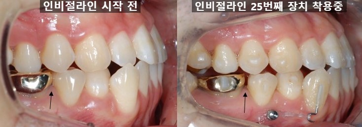 치과위생사의 인비절라인 두번째 이야기 관련 이미지 2