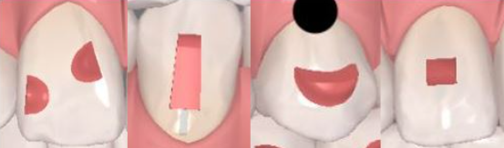 잠실덧니교정 인비절라인으로 컴플렉스 해결! (비발치교정 인비절라인등급 인비절라인후기 ) 관련 이미지 9