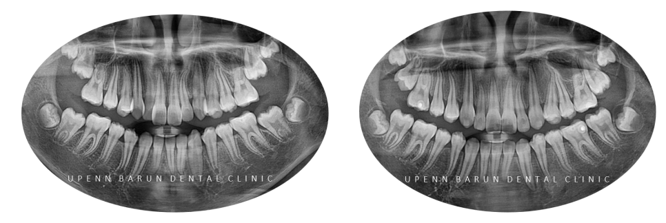 2024년 송파구 단일 치과의원급 중 유일!!! 인비절라인다이아몬드등급 달성한 유펜바른치과의 청소년인비절라인 후기 (청소년반대교합 어린이반대교합 잠실인비절라인잘하는치과) 관련 이미지 6