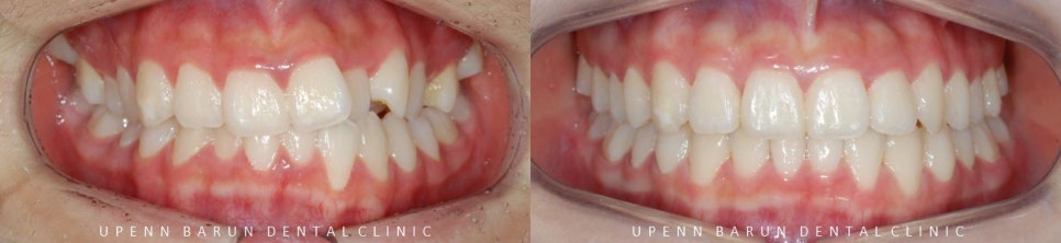 '웃을때 입을 자꾸 가려요'  활짝 웃은 중학생 비발치 인비절라인후기 (잠실새내인비절라인 청소년인비절라인 잠실교정치과) 관련 이미지 4