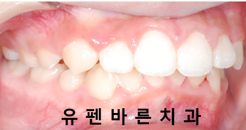 우리아이, 무턱교정 해야할까요? 관련 이미지 7