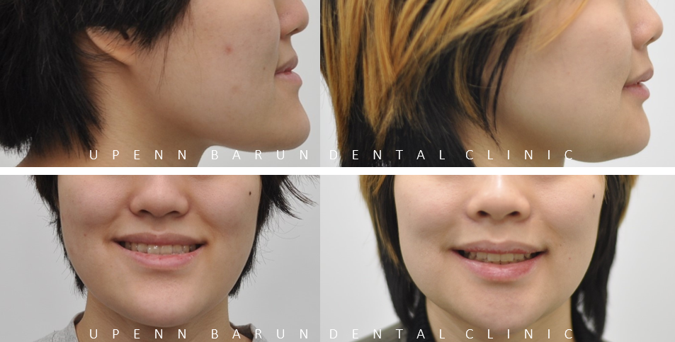 주걱턱교정, 수술교정, 양악수술도 잠실교정치과 유펜바른치과에서 관련 이미지 16