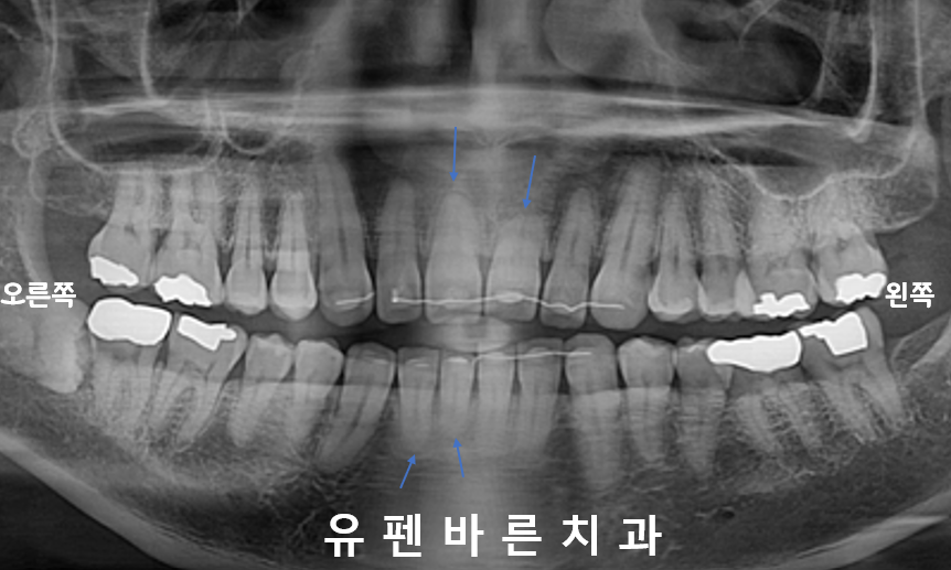 인비절라인으로 재교정, 가능할까용?? 관련 이미지 4