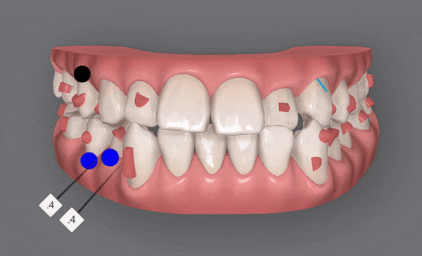 주걱턱 반대교합도 잠실인비절라인 잠실교정치과 유펜바른치과에서!(비발치주걱턱교정 잠실성인교정 반대교합인비절라인 잠실교정치과 주걱턱교정후기) 관련 이미지 10