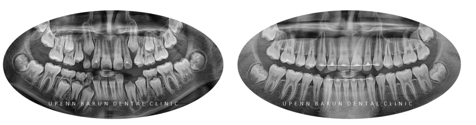 다이아몬드등급치과에서 인비절라인퍼스트로 반대교합 해결! 1차, 2차교정을 한번에!( 어린이반대교합 송파인비절라인퍼스트 잠실엘스상가교정치과 잠실인비절라인퍼스트 인비절라인스피커치과) 관련 이미지 21