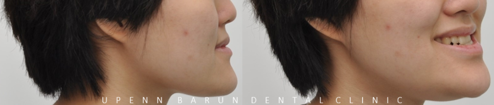 주걱턱교정, 수술교정, 양악수술도 잠실교정치과 유펜바른치과에서 관련 이미지 3