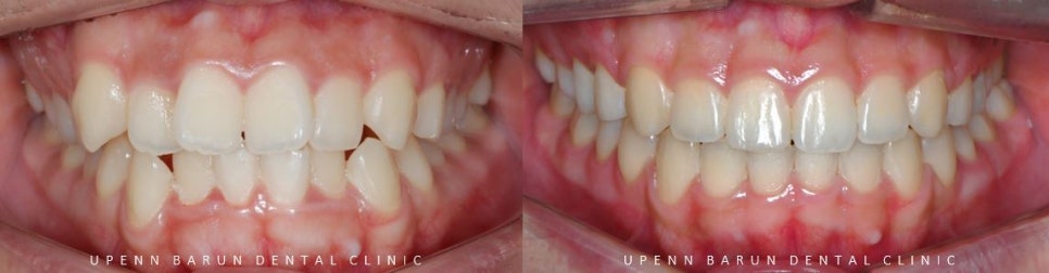 유학생치아교정 유학생교정치과 잠실교정치과 잠실데이몬교정 데이몬클리어교정 Wide Smile (송파교정치과 잠실새내교정치과 강동교정치과 헬리오시티교정치과 예쁜미소 Smile Arc) 관련 이미지 5