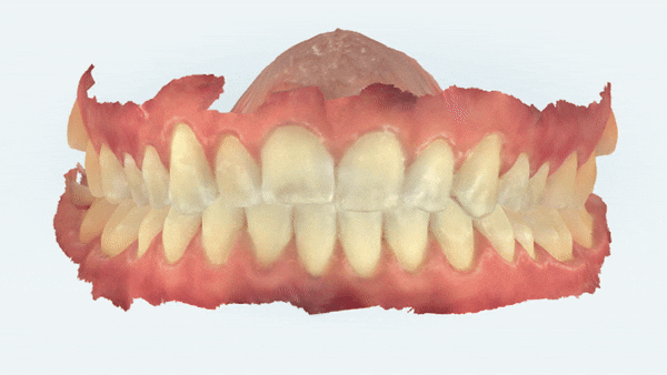 잠실교정치과 유펜바른치과의 인비절라인익스프레스가 특별한 이유 (5개월 인비절라인급속교정 잠실인비절라인 송파인비절라인 인비절라앞니부분교정) 관련 이미지 2