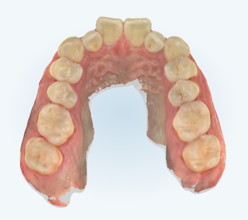 잠실덧니교정 인비절라인으로 컴플렉스 해결! (비발치교정 인비절라인등급 인비절라인후기 ) 관련 이미지 6
