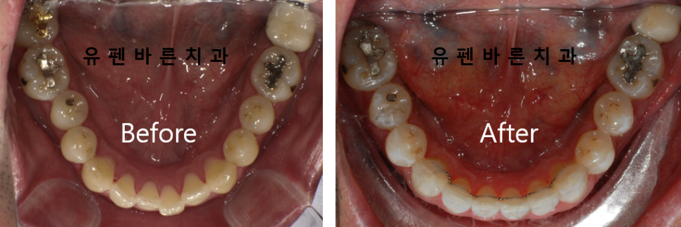 나스닥에 상장한 인비절라인, 잠실투명교정 잠실인비절라인 후기와 치아미백이 궁금하다면? 관련 이미지 16