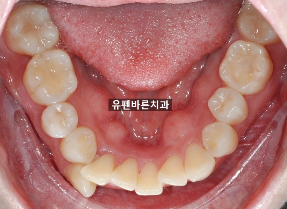 해외거주 중인데 발치교정도 인비절라인으로 가능한가요? 관련 이미지 9