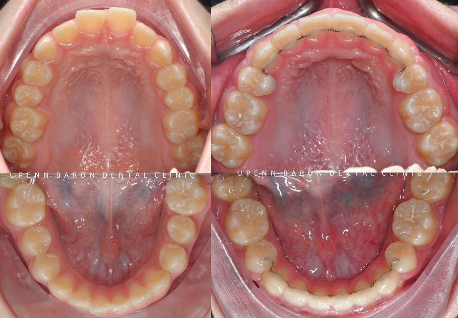 잠실새내역청소년교정 잠실돌출입발치교정은 유펜바른치과!(잠실중학생발치교정 잠실무턱교정 잠실새내소아교정치과 잠실새내교정잘하는치과 발치교정외모변화) 관련 이미지 10