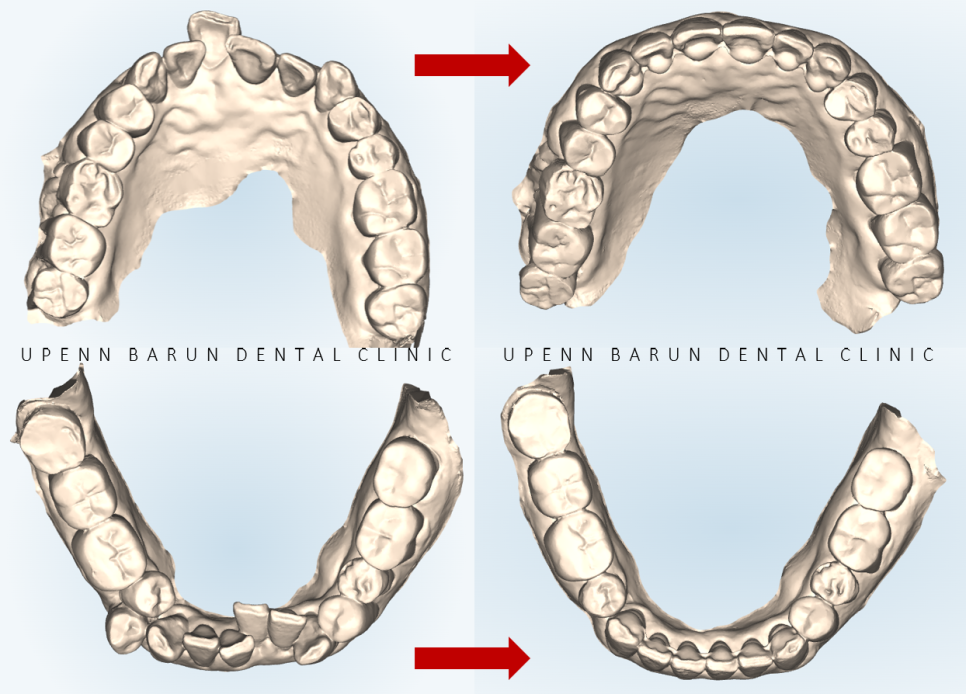평생 삐뚤어진 치아가 고민이셨던 79세 고령환자분이 선택한 송파인비절라인다이아몬드등급 후기 (서울인비절라인전문치과 잠실인비절라인교정치과 노인교정 노인치아교정 노인교정치과) 관련 이미지 7