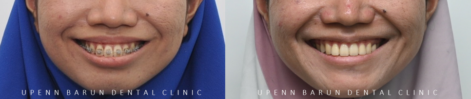 수술이 필요없는 잠실돌출입교정 잠실교정치과 입술이 잘 안다물어져 고민이라면? (돌출입전후 잠실새내교정치과 잠실발치교정 발치교정전후사진) 관련 이미지 12