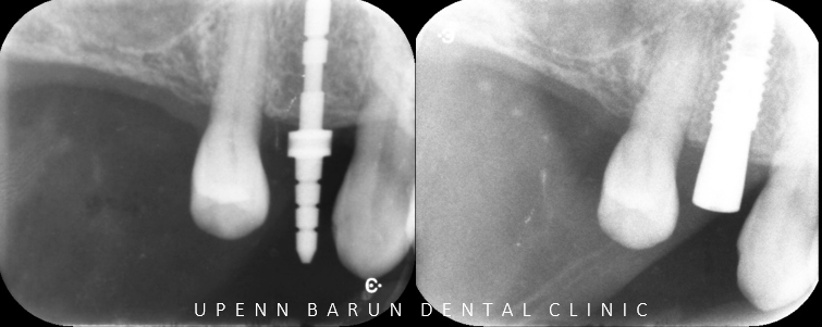 잠실새내역임플란트 잠실새내역치과 유펜바른치과에서 전체임플란트치료 ( 잠실임플란트후기 임플란트기간  전체임플란트) 관련 이미지 9