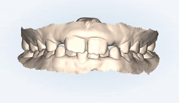 송파인비절라인퍼스트 인비절라인어린이교정 11개월만에 끝낸 후기(잠실인비절라인 잠실파인애플상가교정치과 인비절라인소아교정후기 인비절라인플래티넘엘리트등급) 관련 이미지 3