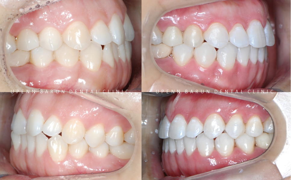 잇몸웃음 거미스마일(gummy smile) 교정후 입동굴 예쁜미소로!(잠실교정치과 거미스마일교정후기 거미스마일교정전후 클라리티세라믹교정 미니스크류교정 미국치과교정과전문의) 관련 이미지 9