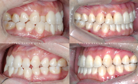 송파인비절라인다이아몬드등급 치과에서 악궁확장장치 없이 반대교합 해결한 후기(인비절라인높은등급 인비절라인반대교합 인비절라인비발치교정 인비절라인잘하는치과 인비절라인교정전문) 관련 이미지 15