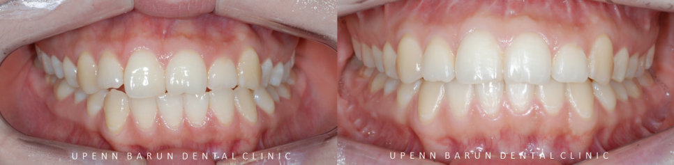 안면비대칭, 잠실수술교정, 잠실양악수술도 유펜바른치과입니다. 관련 이미지 7