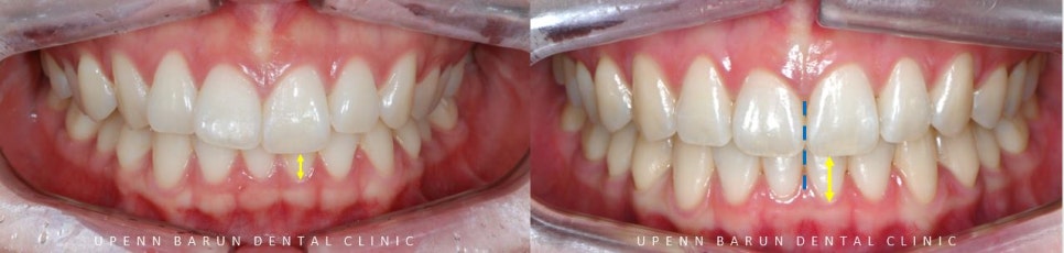 앞니부분교정 인비절라인라이트로 해결하기 (잠실인비절라인치과 송파인비절라인치과 잠실새내인비절라인치과 강동인비절라인치과 헬리오시티인비절라인 송파역인비절라인 석촌역인비절라인) 관련 이미지 13