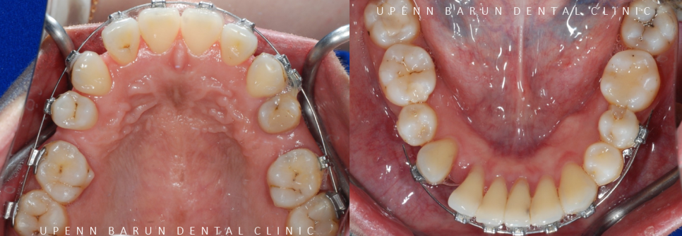 수술이 필요없는 잠실돌출입교정 잠실교정치과 입술이 잘 안다물어져 고민이라면? (돌출입전후 잠실새내교정치과 잠실발치교정 발치교정전후사진) 관련 이미지 5