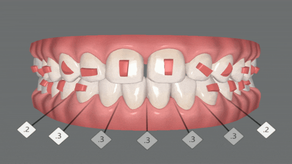 앞니벌어짐 인비절라인익스프레스로 해결하기 (인비절라인앞니부분교정 인비절라인재교정 송파인비절라인 잠실인비절라인 잠실교정치과 인비절라인익스프레스비용) 관련 이미지 7