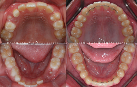 다이아몬드등급치과에서 인비절라인퍼스트로 반대교합 해결! 1차, 2차교정을 한번에!( 어린이반대교합 송파인비절라인퍼스트 잠실엘스상가교정치과 잠실인비절라인퍼스트 인비절라인스피커치과) 관련 이미지 20