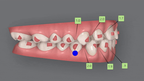 인비절라인높은등급 인비절라인플래티넘엘리트 잠실교정치과 잠실인비절라인 (잠실교정치과 송파인비절라인 인비절라인전후사진 인비절라인후기) 관련 이미지 10