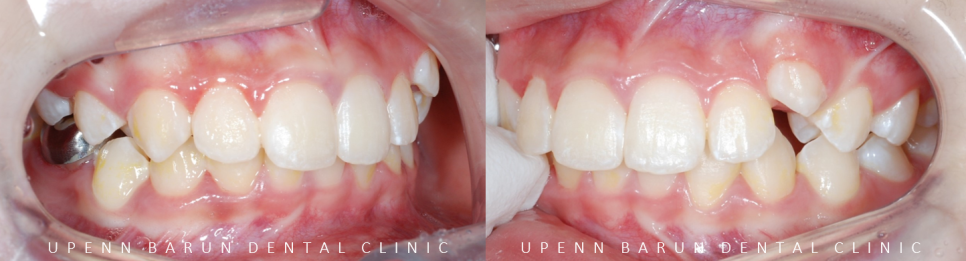 잠실소아인비절라인 잠실어린이인비절라인 송파인비절라인 잠실인비절라인후기 (잠실새내교정치과 엘스상가교정치과 파인애플상가교정치과 잠실새내역인비절라인 청소년교정후기 잠실인비절라인퍼스트) 관련 이미지 4