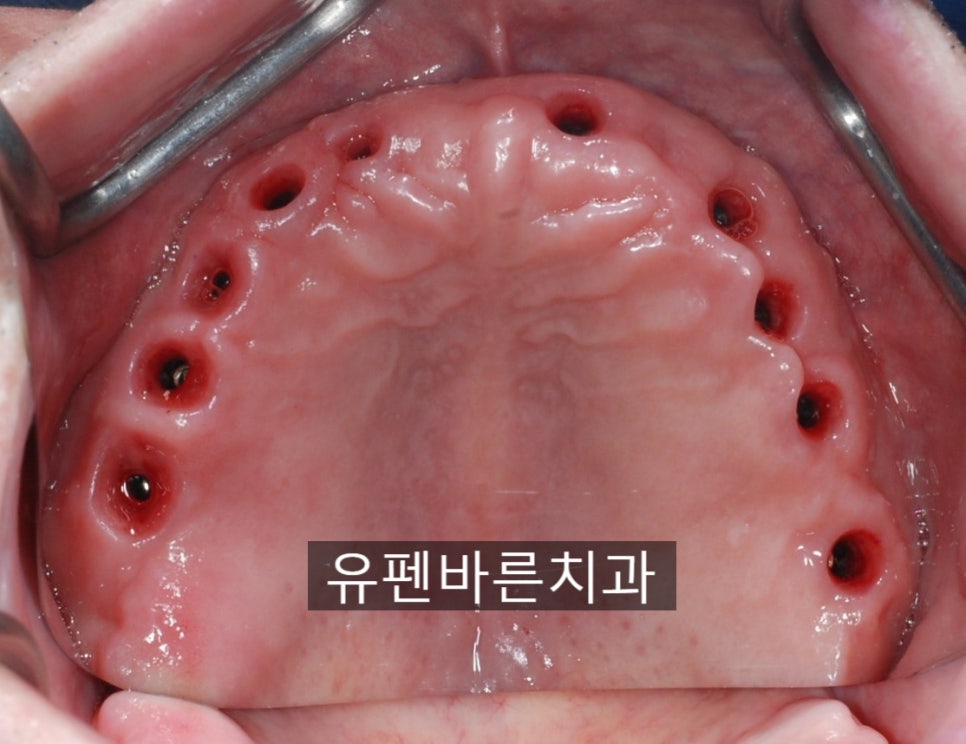 해보니까 임플란트가 편해요!!! 관련 이미지 3