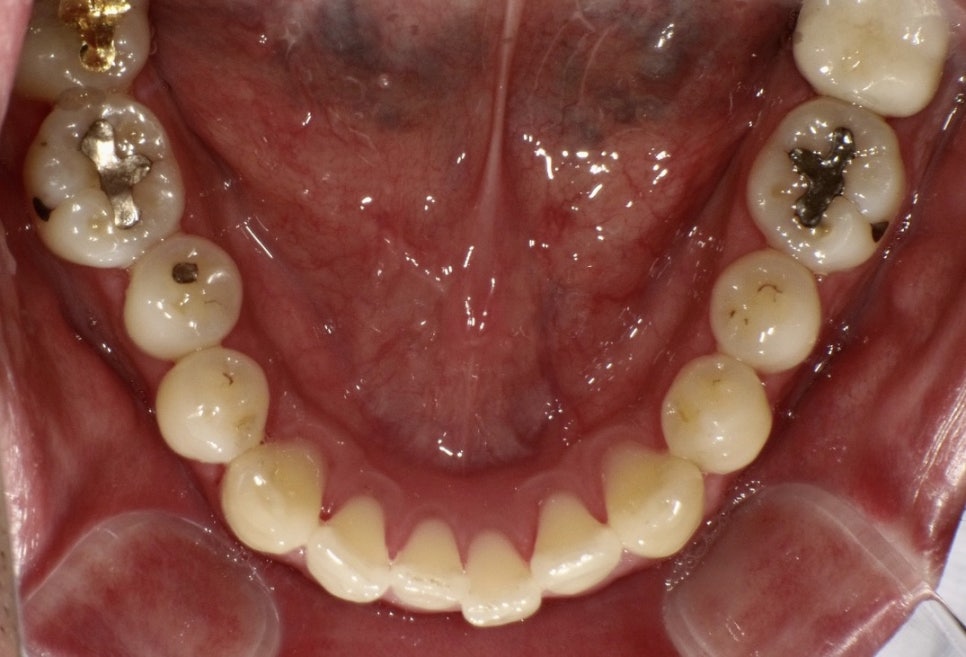 인비절라인의 4가지 종류에 대해 알고 계시나요? 관련 이미지 1