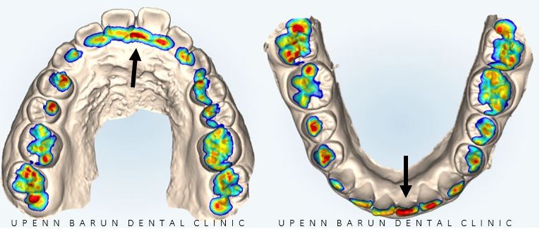 잠실새내역청소년교정 잠실돌출입발치교정은 유펜바른치과!(잠실중학생발치교정 잠실무턱교정 잠실새내소아교정치과 잠실새내교정잘하는치과 발치교정외모변화) 관련 이미지 4