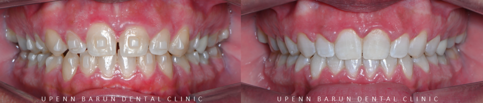 인비절라인높은등급 인비절라인플래티넘엘리트 잠실교정치과 잠실인비절라인 (잠실교정치과 송파인비절라인 인비절라인전후사진 인비절라인후기) 관련 이미지 14