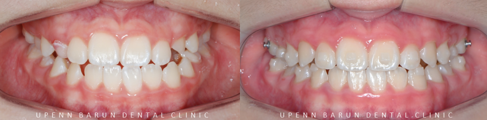 송파인비절라인다이아몬드등급치과 에서 인비절라인으로 1차 2차 교정을 한번에! (송파인비절라인퍼스트 잠실어린이인비절라인 인비절라인소아교정 잠실소아교정 어린이반대교합) 관련 이미지 12