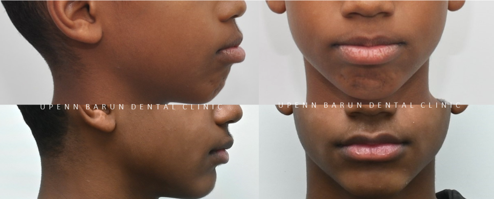 성장기에 돌출입이 고민이라면? 돌출입청소년교정 입술무력증 해결도 유펜바른치과에서! (잠실청소년교정 잠실돌출입교정 돌출입교정기간 발치교정외모변화 외국인교정치과) 관련 이미지 5