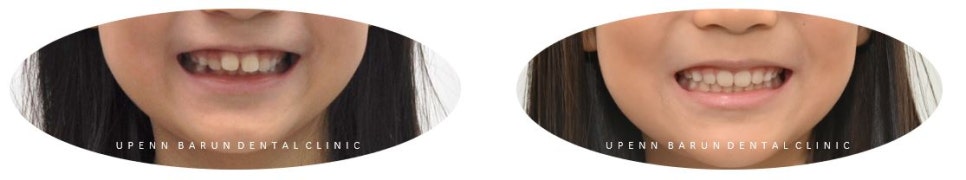 유독 튀어나와 다치기 쉬운 앞니! INVISALIGN FIRST로 8개월만에 끝낸 후기 (송파인비절라인소아교정 인비절라인1차교정 송파인비절라인퍼스트  송파인비절라인어린이교정) 관련 이미지 18