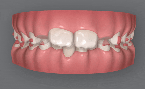 송파인비절라인퍼스트 인비절라인어린이교정 11개월만에 끝낸 후기(잠실인비절라인 잠실파인애플상가교정치과 인비절라인소아교정후기 인비절라인플래티넘엘리트등급) 관련 이미지 11