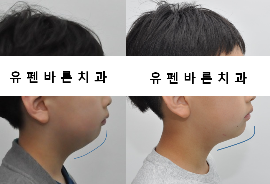 우리아이, 무턱교정 해야할까요? 관련 이미지 8