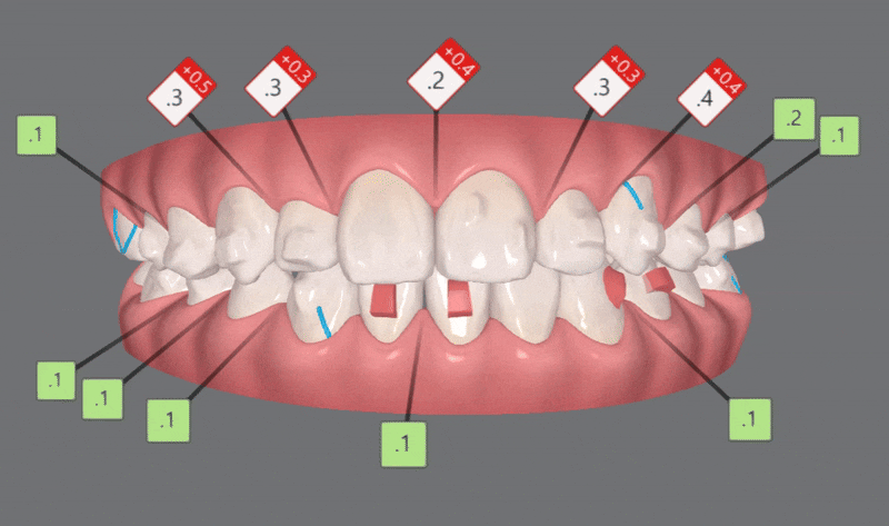 2024년 송파구 단일 치과의원급 중 유일!!! 인비절라인다이아몬드등급 달성한 유펜바른치과의 청소년인비절라인 후기 (청소년반대교합 어린이반대교합 잠실인비절라인잘하는치과) 관련 이미지 12