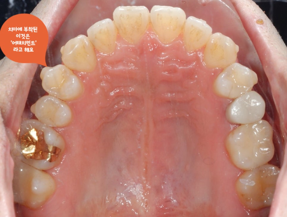 치과위생사의 인비절라인 두번째 이야기 관련 이미지 1