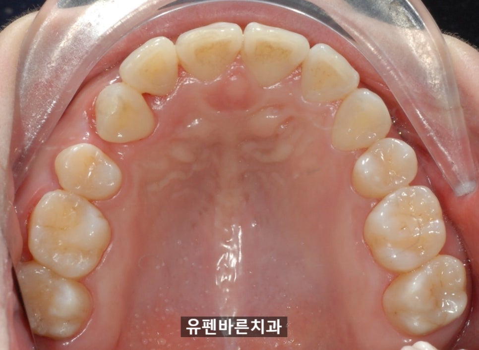 해외거주 중인데 발치교정도 인비절라인으로 가능한가요? 관련 이미지 8